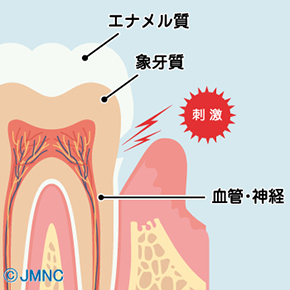 虫歯とは