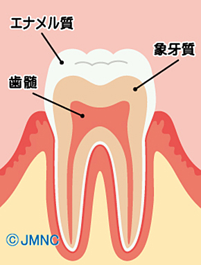 虫歯の進行