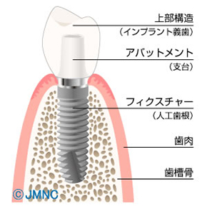 インプラント治療とは